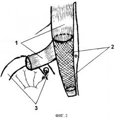 Способ пластики задней стенки влагалища прямой мышцы живота при хирургическом лечении несформированных свищей желудочно-кишечного тракта мышечным лоскутом на сосудистой ножке (патент 2448655)