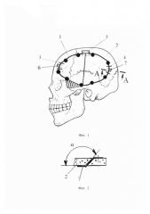 Способ створчатой трепанации черепа (патент 2640996)