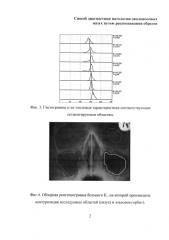 Способ диагностики патологии околоносовых пазух путем распознавания образов (патент 2585700)