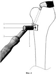 Способ лечения застарелого повреждения сухожилия надостной мышцы и устройство для его осуществления (патент 2527361)