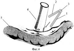 Клипса для холедоходуоденального анастомоза (патент 2275870)