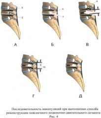Способ реконструкции поясничного позвоночно-двигательного сегмента (патент 2527150)