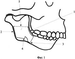 Способ увеличения длины тела и ветви нижней челюсти у детей (патент 2362499)