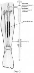Способ лечения аневризмальных кист длинных трубчатых костей (патент 2386408)