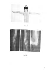 Способ восстановления функции локтевого сустава при неправильно сросшихся переломах мыщелка плечевой кости (патент 2581711)