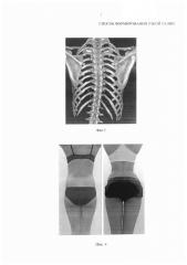 Способ формирования узкой талии (патент 2652964)