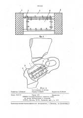 Способ пластики капсулы тазобедренного сустава (патент 1362465)