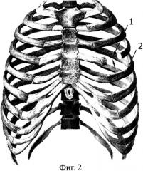 Способ лечения реберного дефекта грудной стенки (патент 2417774)
