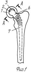 Эндопротез проксимального конца бедренной кости (патент 2307623)
