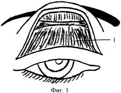 Способ хирургического лечения птоза верхнего века тяжелой степени (патент 2392908)