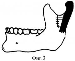 Способ хирургического лечения костного анкилоза височно-нижнечелюстного сустава и недоразвития нижней челюсти (патент 2411921)
