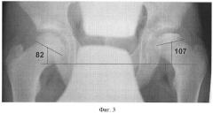 Способ оценки подвывиха головки бедра при болезни легг-кальве-пертеса (патент 2436509)