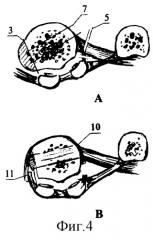 Способ лечения деформаций стопы у детей (патент 2295311)