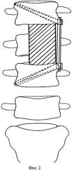 Способ остеосинтеза позвоночника при травмах и заболеваниях (патент 2559275)