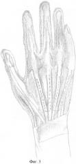 Способ восстановления активного разгибания межфаланговых суставов трехфаланговых пальцев кисти при нейрогенных деформациях (патент 2397722)