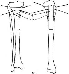 Способ хирургического лечения деформации длинных трубчатых костей при экзостозной хондродисплазии у детей и подростков (патент 2319466)
