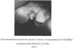 Способ восстановления дефектов зубов (патент 2460490)