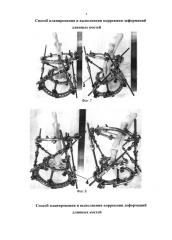 Способ планирования и выполнения коррекции деформаций длинных костей (патент 2641840)