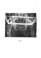 Способ лечения больных с повреждениями и последствиями повреждений вертлужной впадины (патент 2644713)