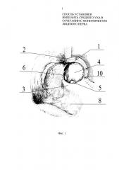 Способ установки импланта среднего уха в сочетании с мониторингом лицевого нерва (патент 2616174)