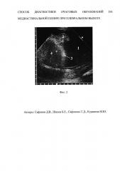 Способ дифференциальной диагностики очаговых образований на медиастинальной плевре при плевральном выпоте (патент 2626685)