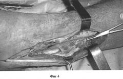 Способ пластики островковым мышечным лоскутом после радикальной хирургической обработки остеомиелитического очага в нижней трети малоберцовой кости (патент 2336838)