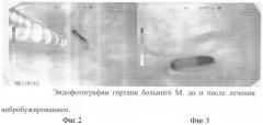 Способ вибробужирования стенозов гортани и трахеи (патент 2292848)