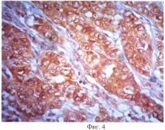 Способ прогнозирования гематогенного метастазирования при кишечном типе рака желудка (патент 2470308)