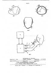 Устройство для прямого массажа сердца (патент 764676)