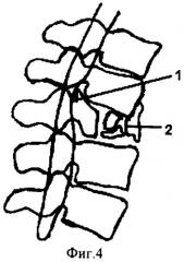 Способ хирургического лечения последствий переломов позвоночника (патент 2279859)