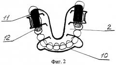 Аппарат для лечения гнатической формы мезиальной окклюзии у подростков (патент 2547794)