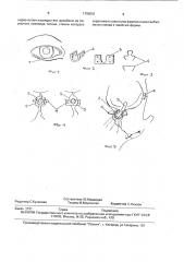 Способ лечения нижнеглазничного перелома (патент 1799551)