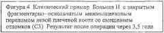 Способ лечения тяжелых внутрисуставных переломов локтевого сустава (патент 2463980)