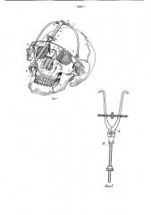 Аппарат для лечения переломов верхней челюсти (патент 938971)
