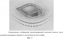 Способ формирования инфрамаммарной складки при двухэтапной реконструкции молочной железы (патент 2567790)