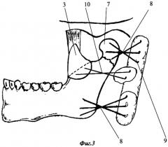 Метод внутриротового остеосинтеза под видеоэндоскопическим контролем при переломах мыщелкового отростка нижней челюсти с вывихом головки в подвисочную ямку (патент 2311143)