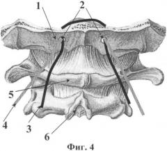 Способ фиксации шейно-затылочной области позвоночника (патент 2342915)