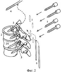 Способ этапной хирургической коррекции деформации позвоночного столба (патент 2392888)