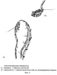 Новый способ формирования эзофагогастроанастомоза в условиях недостатка пластического материала путем модификации задней губы (патент 2248185)