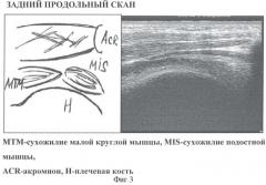 Способ ультразвуковой диагностики типа положения акромиального отростка лопатки относительно головки плечевой кости (патент 2367346)