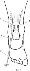 Способ оперативного лечения застарелых разрывов ахиллова сухожилия (патент 2289345)