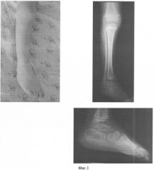 Способ лечения косолапости с внутренней торсией костей голени у детей с трехлетнего возраста (патент 2346662)