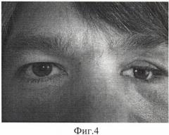 Способ протезирования культи глазного яблока (патент 2485915)