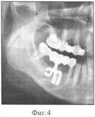 Дентальный внутрикостный имплантат и материал с эффектом памяти формы для его изготовления (патент 2397732)