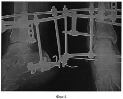 Способ лечения застарелых неправильно сросшихся пронационно-эверсионных переломов дистального отдела костей голени (патент 2528819)