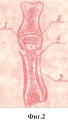 Способ артропластики межфаланговых суставов пальцев кисти (патент 2465854)