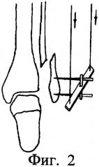 Способ лечения перелома малоберцовой кости в нижней трети диафиза с повреждением межберцового синдесмоза голени (патент 2282411)