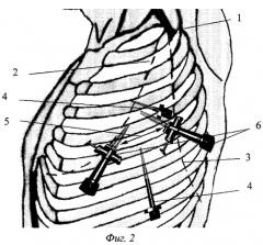 Способ выбора мини-доступа к органам грудной клетки (патент 2254070)