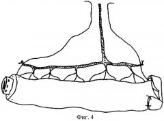 Способ формирования цистостомы (патент 2277866)