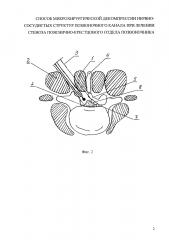 Способ микрохирургической декомпрессии нервно-сосудистых структур позвоночного канала при лечении стеноза пояснично-крестцового отдела позвоночника (патент 2628653)